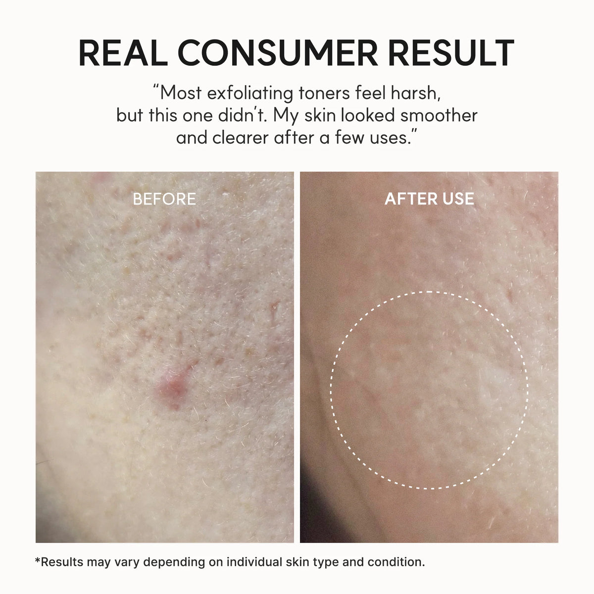 Arencia - Eraser Shot Glycolic Acid Exfoliator - 200ml | Exfoliante Facial con Ácido Glicólico