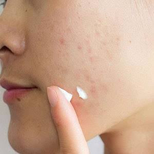 SKIN1004 - Madagascar Centella Tea-Trica Spot Cream - 20ml | Crema para Imperfecciones con Centella y Árbol de Té