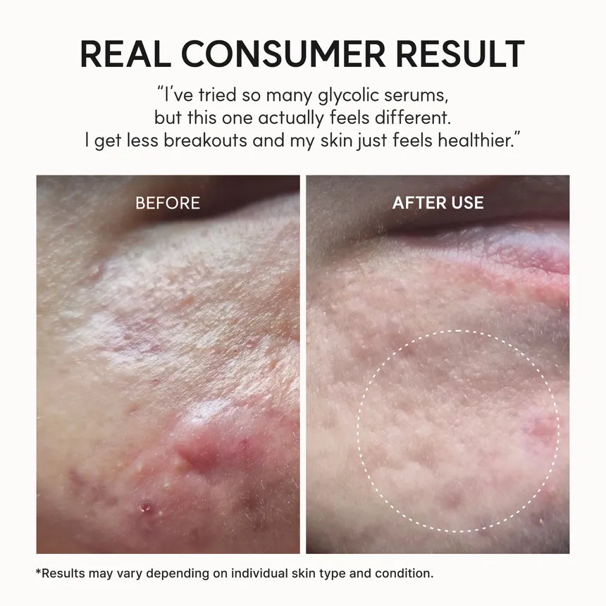 Arencia - Eraser Shot Glycolic Acid Booster - 30ml | Booster Exfoliante Con Ácido Glicólico Para Renovar La Textura Y Unificar El Tono