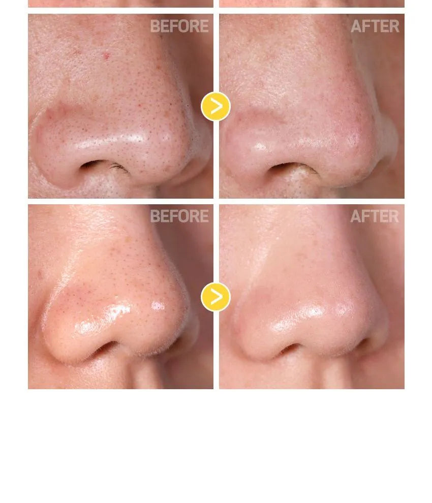 Jumiso - Blackhead Melting Softener 150ml + Cotton Pads (40 pads) set | Derrite puntos negros